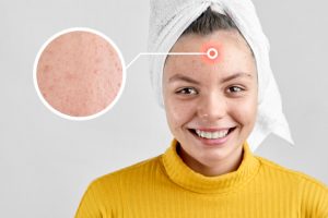 https://pruebas.clinicaherrera.es/wp-content/uploads/2020/11/acne_infantil_1-300x200.jpg