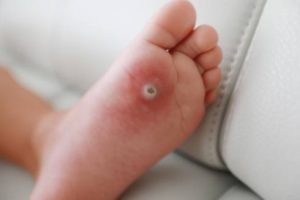 https://pruebas.clinicaherrera.es/wp-content/uploads/2020/11/verrugas_molluscum-300x200.jpg