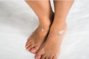 https://pruebas.clinicaherrera.es/wp-content/uploads/2020/11/vitiligo-300x200.jpg
