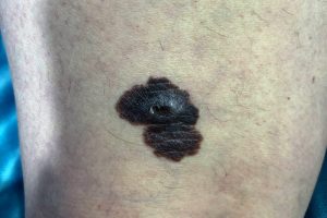 https://pruebas.clinicaherrera.es/wp-content/uploads/2021/02/unidad_Melanoma-300x200.jpg